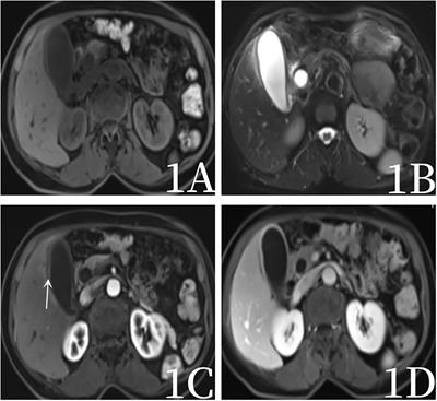 Application of 18F-FDG PET/CT imaging in gallbladder inflammatory pseudotumor with elevated CA199: a case report and review of literature